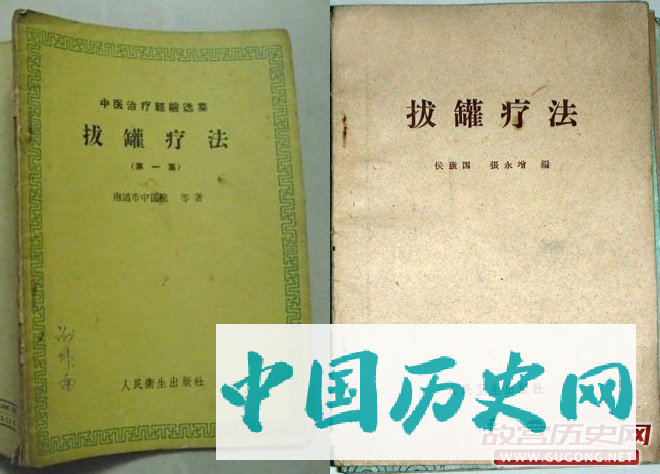 1950-1970年代，因医疗资源有限，政府大力提倡“拔罐疗法”