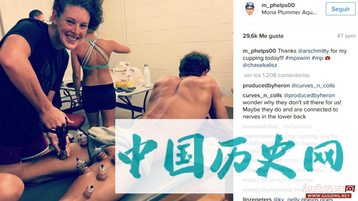 菲尔普斯在社交平台上晒出自己接受“拔罐”的图片