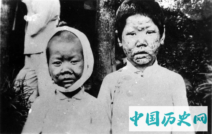 摄影师拍摄的广东地区的麻风病患者，患病后自生自灭