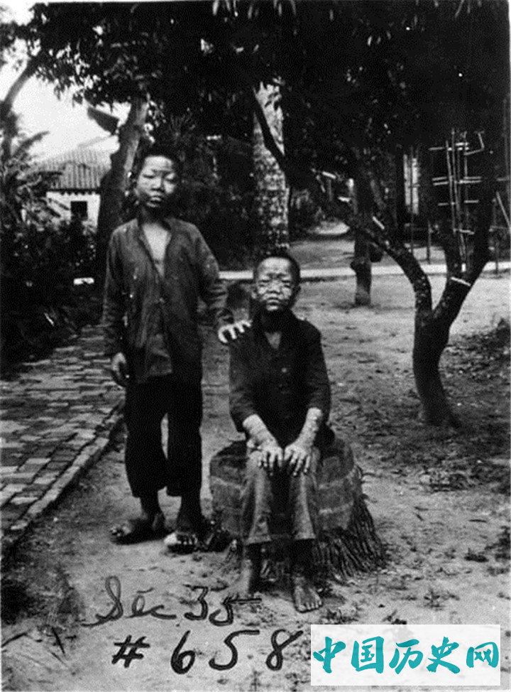 摄影师拍摄的广东地区的麻风病患者，患病后自生自灭